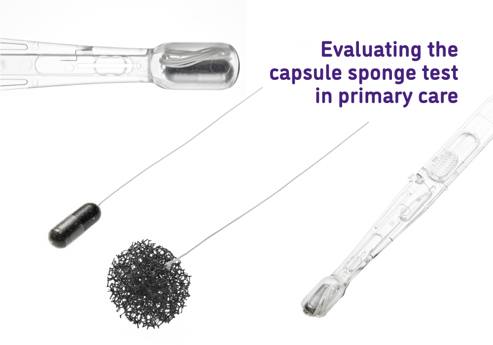 Sponge Testing Successful pilot of test to detect Barrett’s oesophagus in West of ...